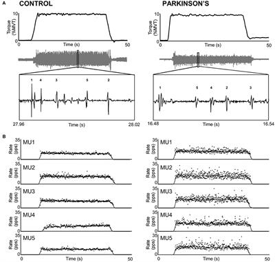 Motor Unit Discharge Variability Is Increased in Mild-To-Moderate Parkinson's Disease